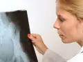 Lekarka analizuje zdjęcie RTG miednicy, szukając oznak raka kości.