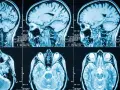 Przekroje mózgu na rezonansie magnetycznym, pokazujące jego strukturę. Obraz może pomóc w diagnostyce objawów guza mózgu.