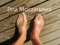 Dna moczanowa: obrzęknięty, czerwony paluch stopy po prawej, zdrowa stopa po lewej. Przyczyny tej choroby mogą być różne.