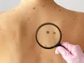 Dłoń w różowej rękawiczce bada pieprzyk pod lupą na plecach, gdzie widocznych jest wiele znamion. Ważne jest, by odróżnić zwykły pieprzyk od czerniaka.