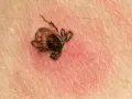 Makro zbliżenie na kleszcza przyczepionego do ludzkiej skóry. Widać jego nogi i odwłok.