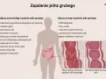 Ilustracja przedstawia objawy zapalenia jelita grubego, w tym bóle brzucha, biegunkę, krew w kale i utratę masy ciała.