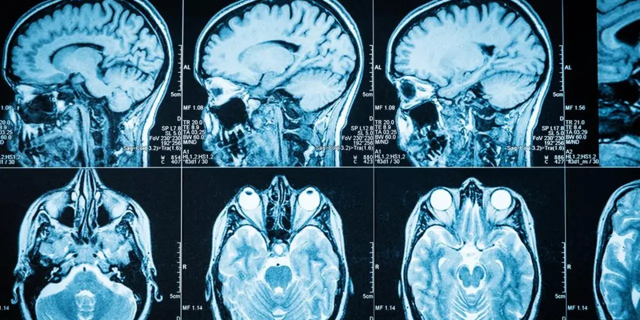 Przekroje mózgu na rezonansie magnetycznym, pokazujące jego strukturę. Obraz może pomóc w diagnostyce objawów guza mózgu.