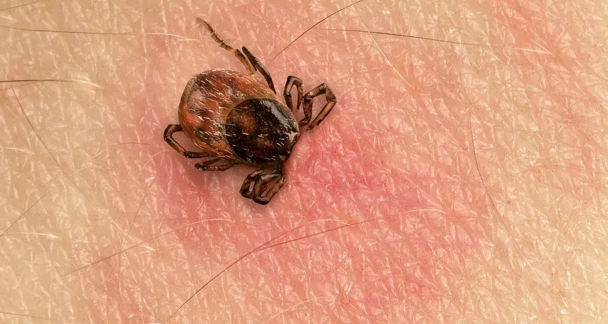 Makro zbliżenie na kleszcza przyczepionego do ludzkiej skóry. Widać jego nogi i odwłok.