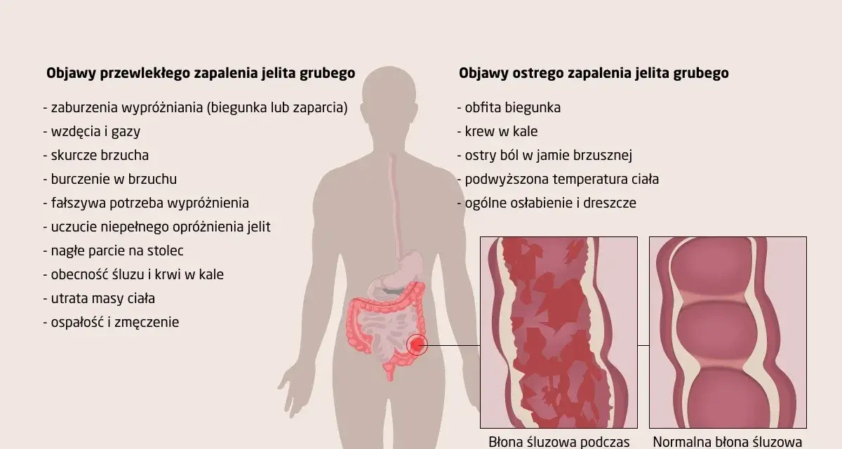 Ilustracja przedstawia objawy zapalenia jelita grubego, w tym bóle brzucha, biegunkę, krew w kale i utratę masy ciała.