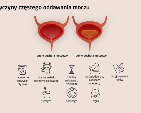 Ilustracja pokazuje przyczyny częstego oddawania moczu: nadmierne picie, choroby, wiek, nadwagę, ciążę i leki.