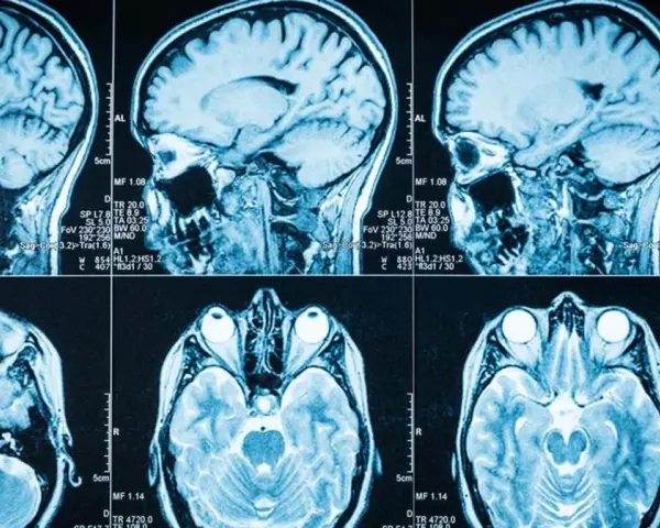 Przekroje mózgu na rezonansie magnetycznym, pokazujące jego strukturę. Obraz może pomóc w diagnostyce objawów guza mózgu.