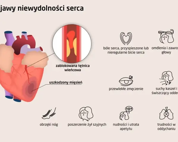 Objawy niewydolności serca: ból w klatce, omdlenia, zmęczenie, obrzęki nóg, kaszel, duszności, nudności. Zablokowana tętnica wieńcowa i uszkodzony mięsień sercowy.