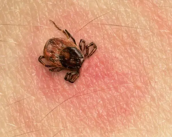 Makro zbliżenie na kleszcza przyczepionego do ludzkiej skóry. Widać jego nogi i odwłok.