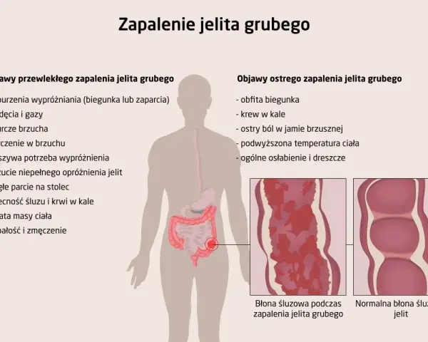 Ilustracja przedstawia objawy zapalenia jelita grubego, w tym bóle brzucha, biegunkę, krew w kale i utratę masy ciała.