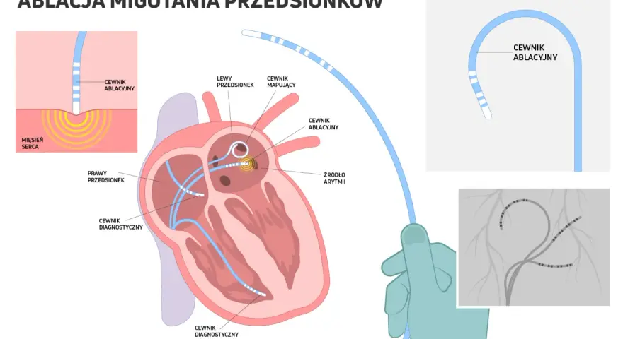 Ilustracja wyjaśnia, co to ablacja migotania przedsionków. Pokazuje cewniki diagnostyczne i ablacyjne w sercu, lokalizujące źródło arytmii.