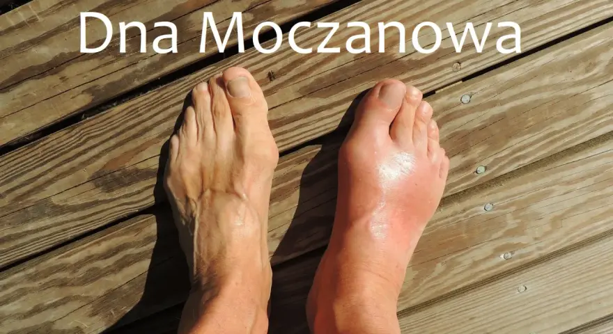 Dna moczanowa: obrzęknięty, czerwony paluch stopy po prawej, zdrowa stopa po lewej. Przyczyny tej choroby mogą być różne.