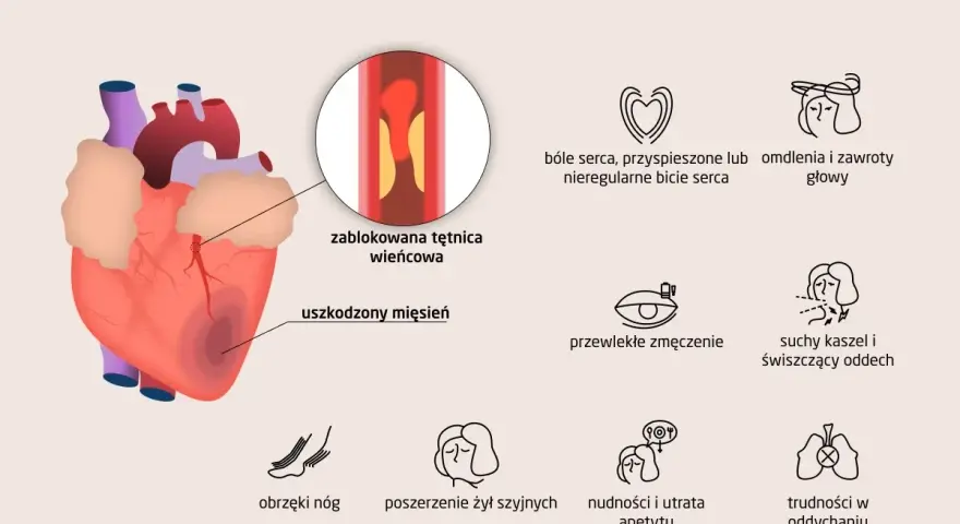 Objawy niewydolności serca: ból w klatce, omdlenia, zmęczenie, obrzęki nóg, kaszel, duszności, nudności. Zablokowana tętnica wieńcowa i uszkodzony mięsień sercowy.
