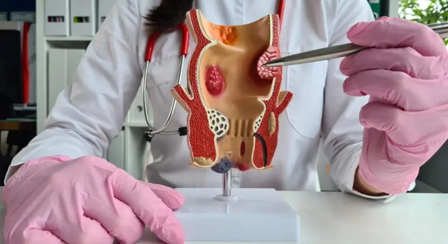 Lekarz w różowych rękawiczkach pokazuje model odbytu, wskazując na hemoroidy, które mogą powodować krew z odbytu.