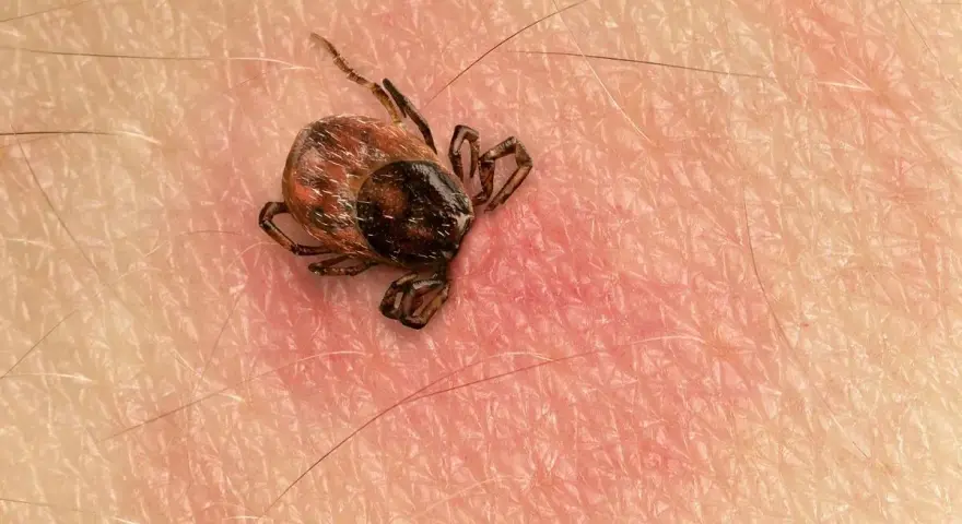 Makro zbliżenie na kleszcza przyczepionego do ludzkiej skóry. Widać jego nogi i odwłok.