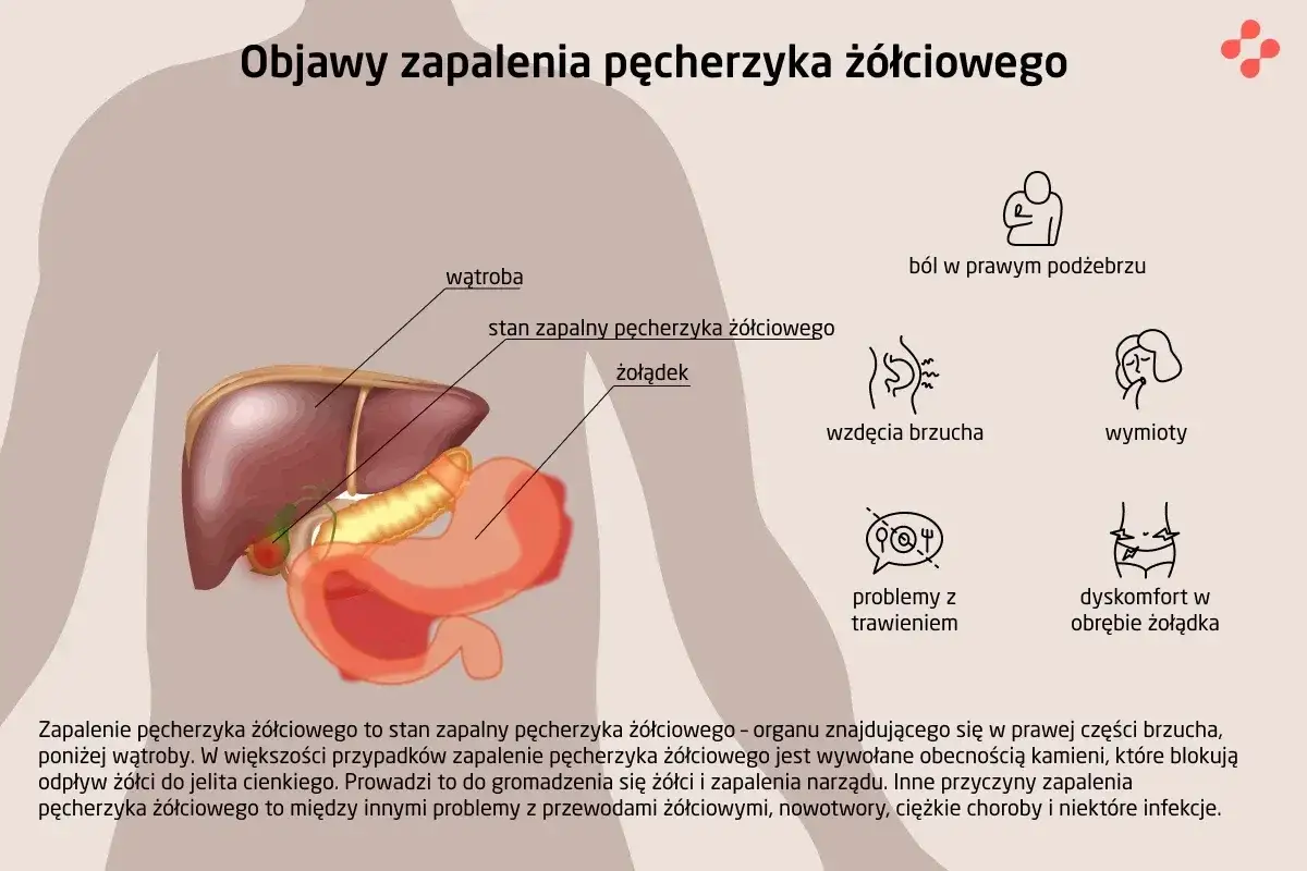 Ilustracja przedstawia anatomię jamy brzusznej z zaznaczonym zapaleniem pęcherzyka żółciowego. Objawy to m.in. ból po prawej stronie brzucha.