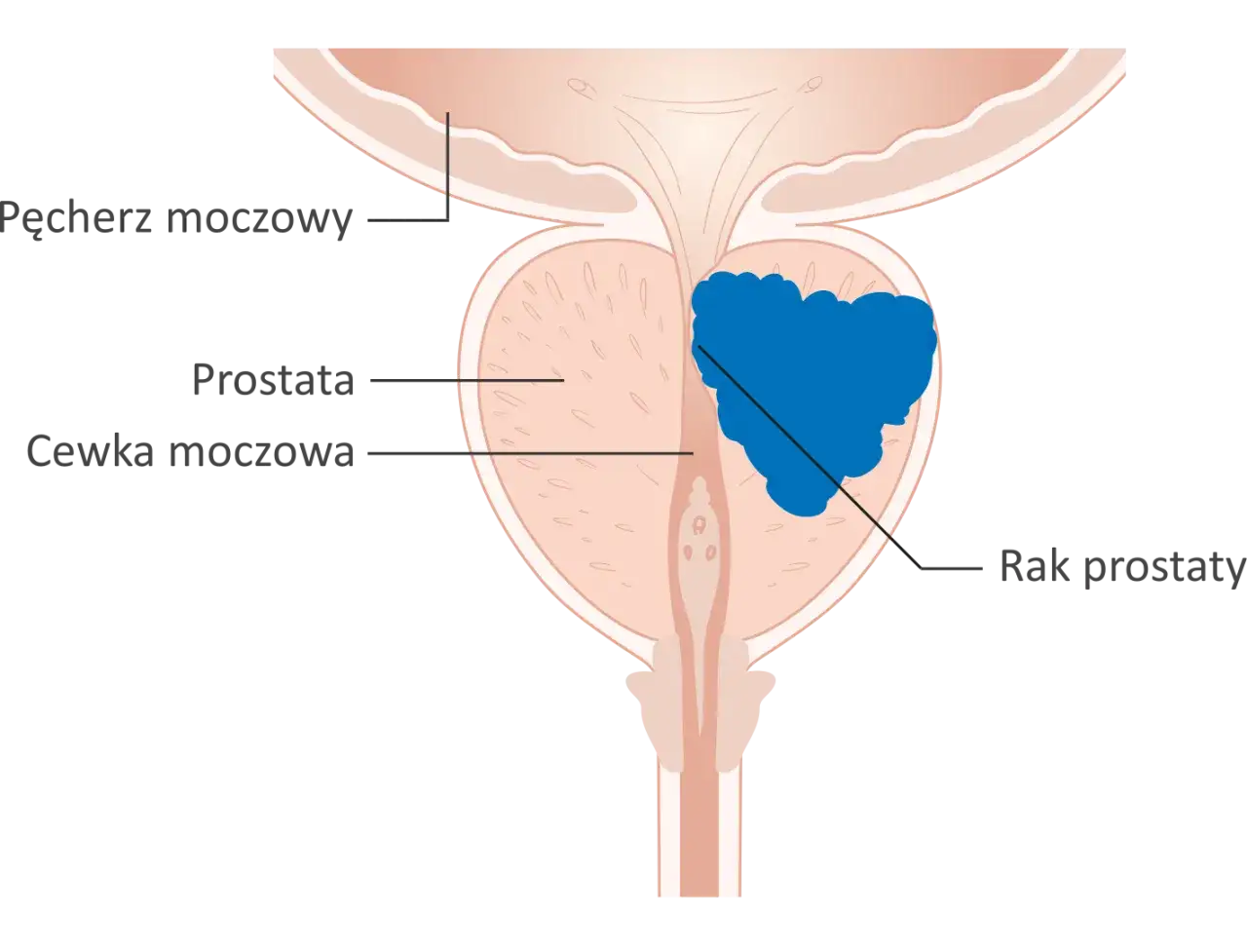 Rak prostaty może powodować ból w podbrzuszu. Schemat przedstawia pęcherz, cewkę moczową i prostatę z guzem nowotworowym.