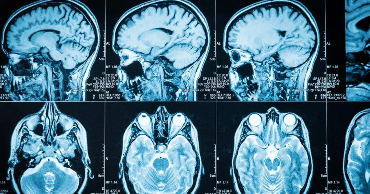 Przekroje mózgu na rezonansie magnetycznym, pokazujące jego strukturę. Obraz może pomóc w diagnostyce objawów guza mózgu.