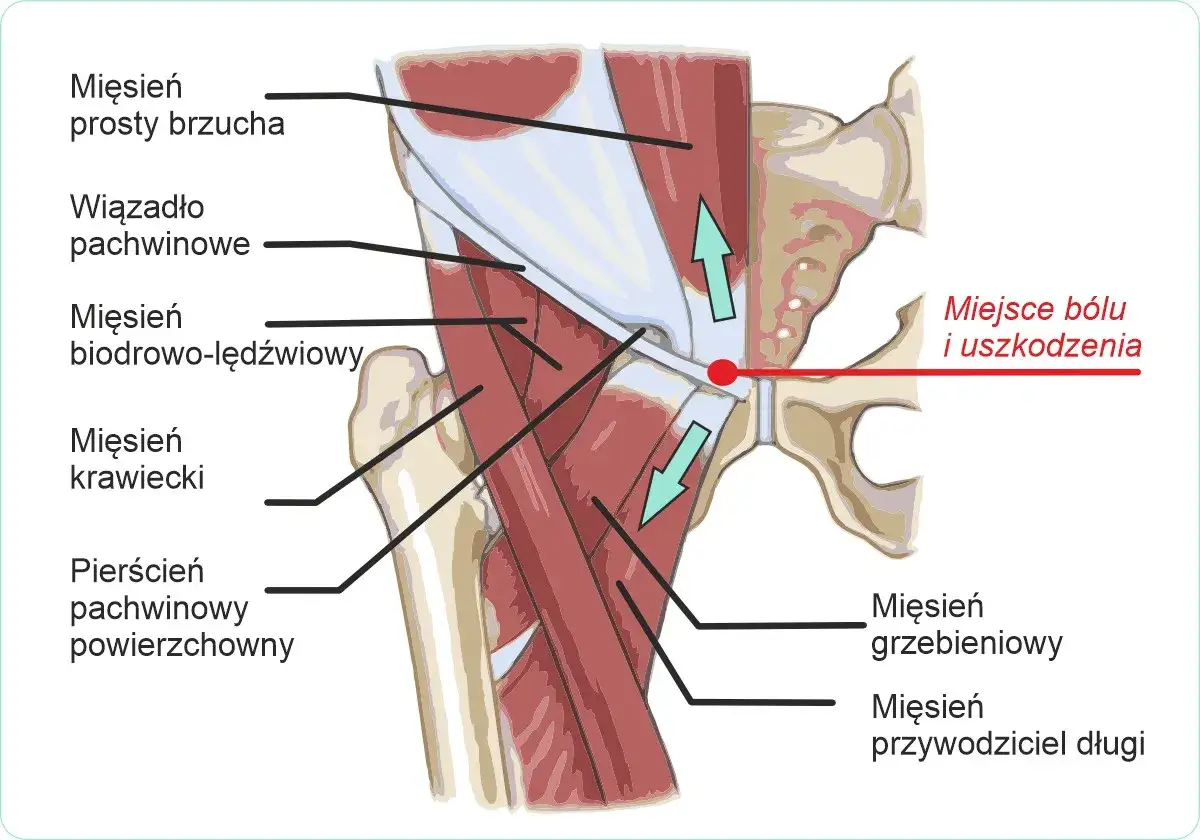Anatomia pokazuje miejsce bólu w pachwinie, gdzie mięsień biodrowo-lędźwiowy i przywodziciel długi mogą być uszkodzone.