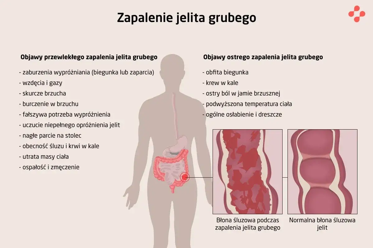 Ilustracja przedstawia objawy zapalenia jelita grubego, w tym bóle brzucha, biegunkę i krew w kale. Pokazuje też wygląd błony śluzowej jelita grubego podczas zapalenia i w stanie normalnym.