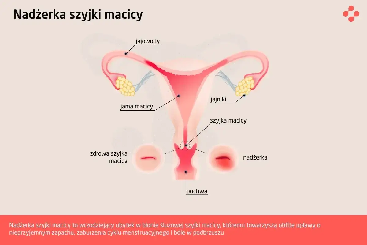 Ilustracja przedstawia budowę narządów rodnych kobiety, z zaznaczoną nadżerką szyjki macicy, która jest ubytkiem w błonie śluzowej.