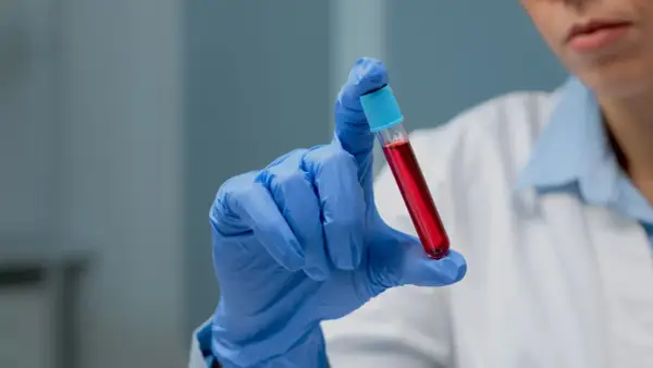 Ręka w niebieskiej rękawiczce trzyma probówkę z czerwoną cieczą. To może być próbka do badań, np. PDW co to jest, czyli wskaźnik anizocytozy płytek krwi.